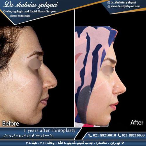 جراحی بینی 344
