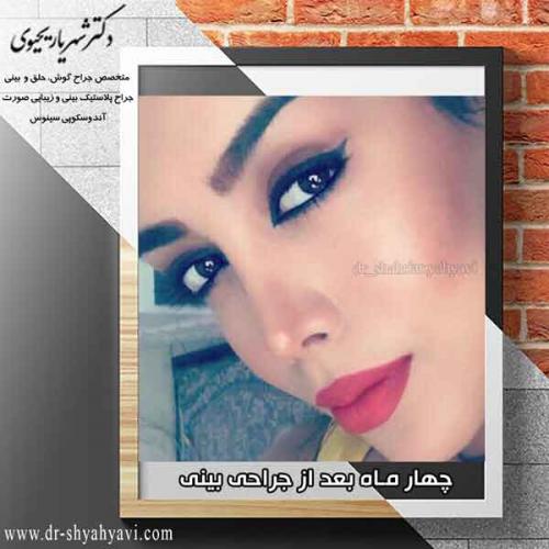 جراحی بینی 346