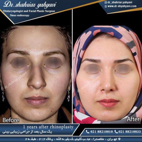 جراحی بینی 346 (1)