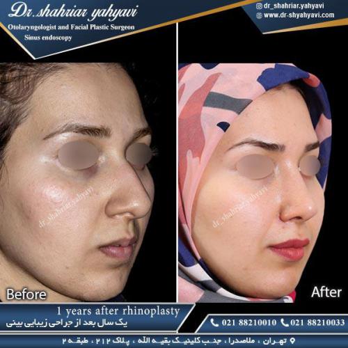 جراحی بینی 347