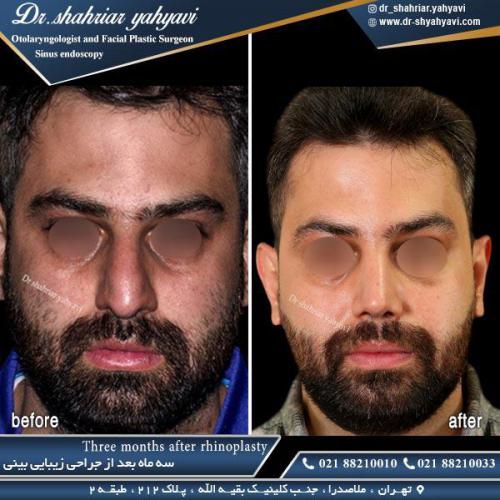 جراحی بینی 348