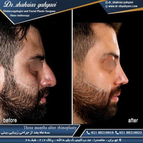 جراحی بینی 349