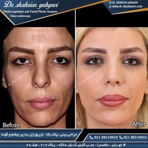 جراحی بینی 351