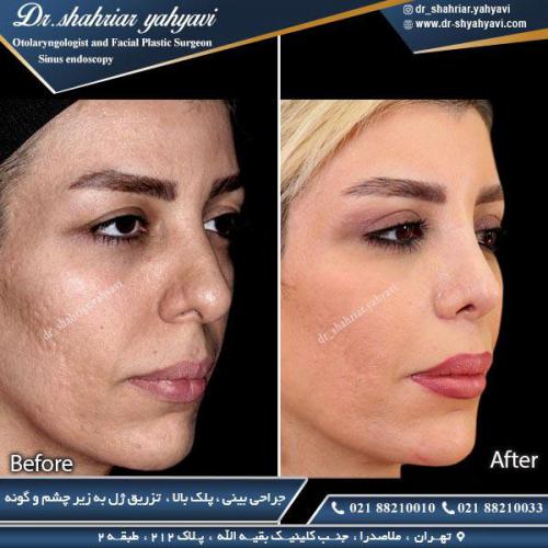 جراحی بینی 352