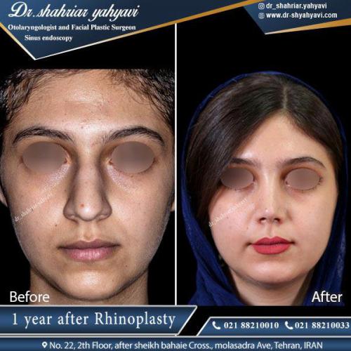 جراحی بینی 354