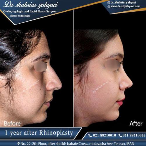 جراحی بینی 355