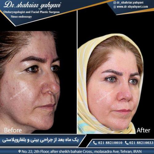 جراحی بینی 356