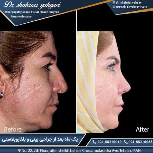جراحی بینی 357