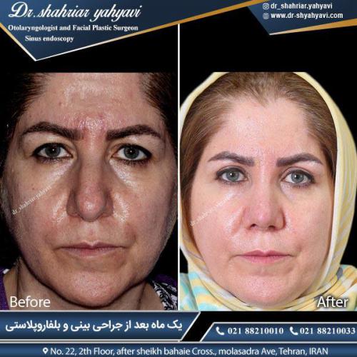 جراحی بینی 358