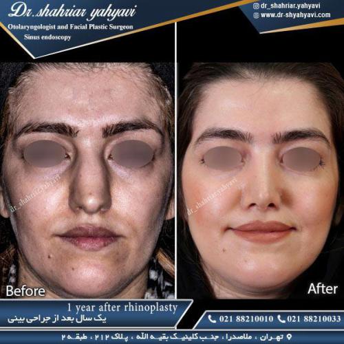 جراحی بینی 359