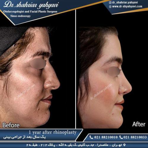 جراحی بینی 360