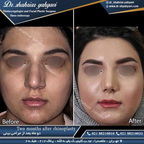 جراحی بینی 361