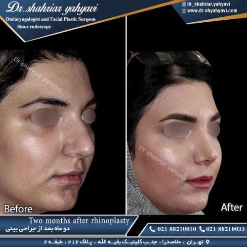 جراحی بینی 362