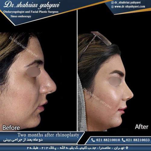 جراحی بینی 363