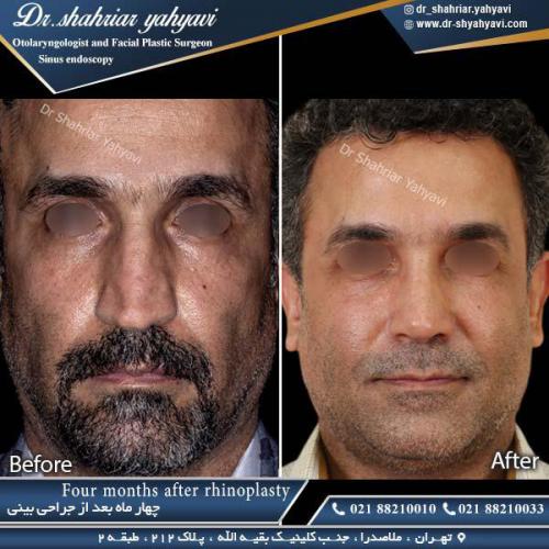 جراحی بینی 364