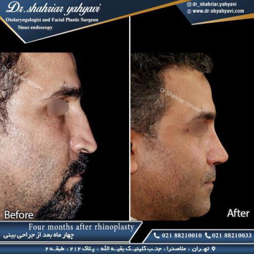 جراحی بینی 366