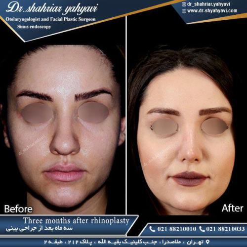 جراحی بینی 367