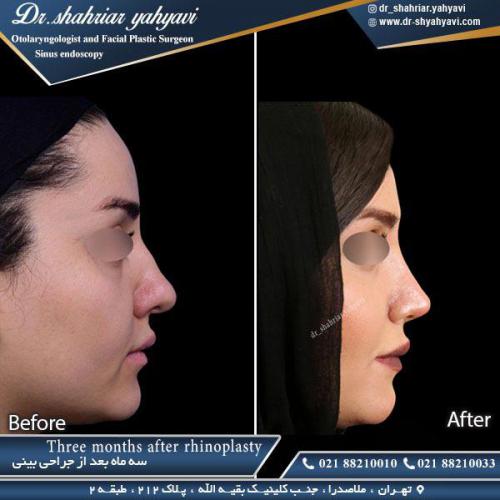 جراحی بینی 368