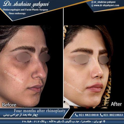 جراحی بینی 369