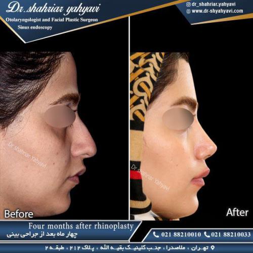 جراحی بینی 370