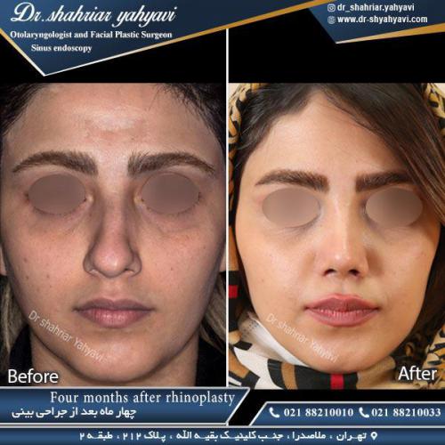 جراحی بینی 371