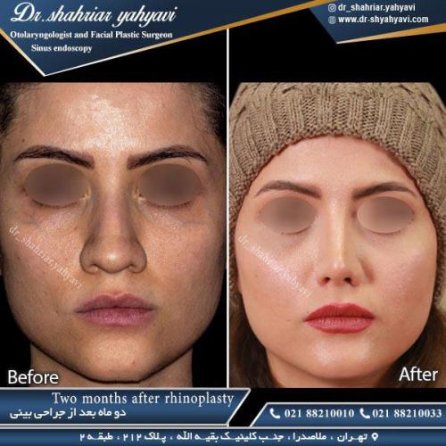 جراحی بینی 372
