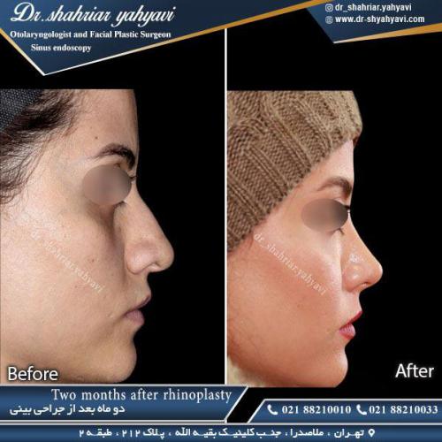 جراحی بینی 373