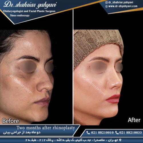 جراحی بینی 374