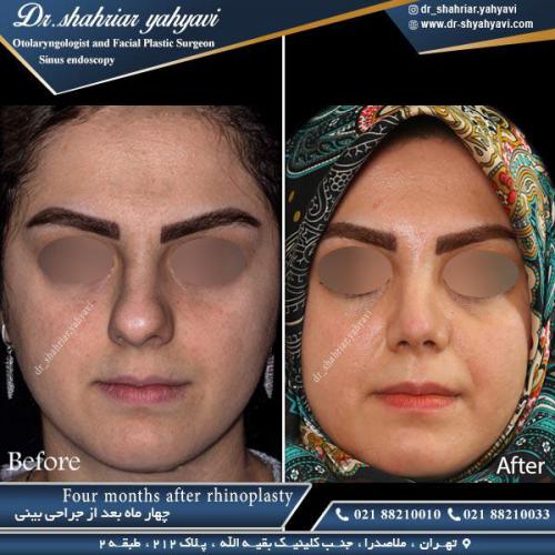 جراحی بینی 375