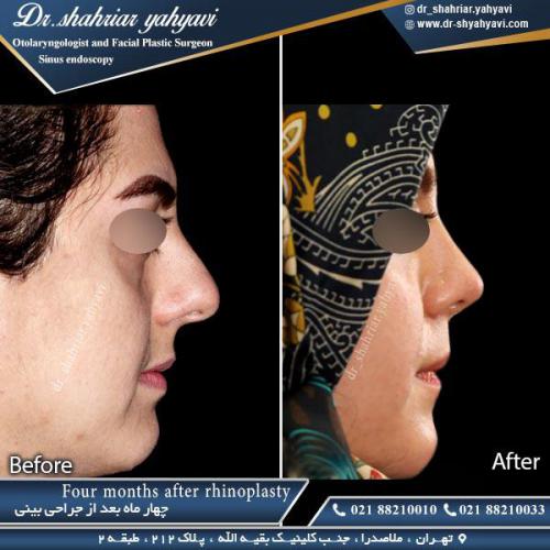 جراحی بینی 376