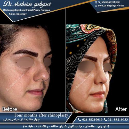 جراحی بینی 377