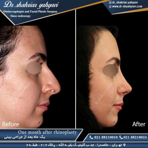 جراحی بینی 378