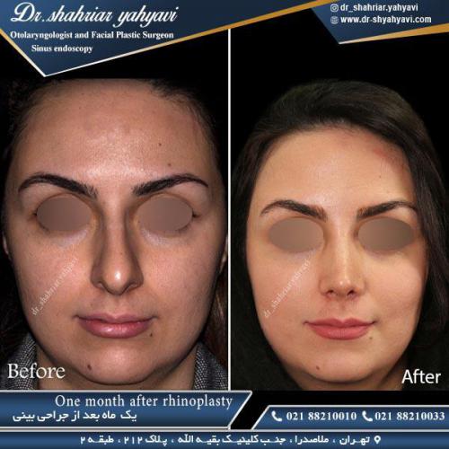 جراحی بینی 379