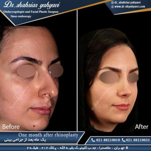 جراحی بینی 380