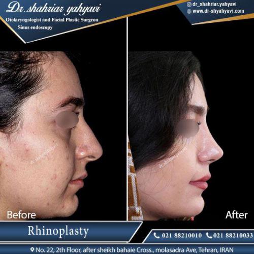 جراحی بینی 381
