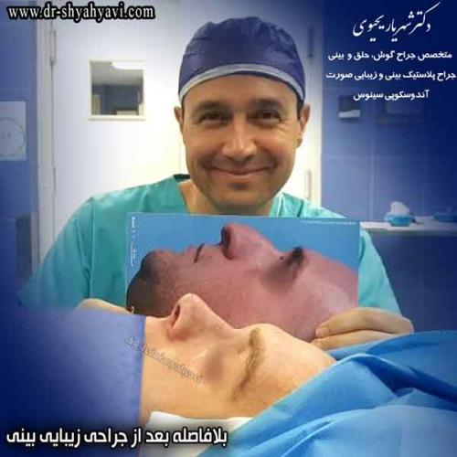 جراحی بینی 382