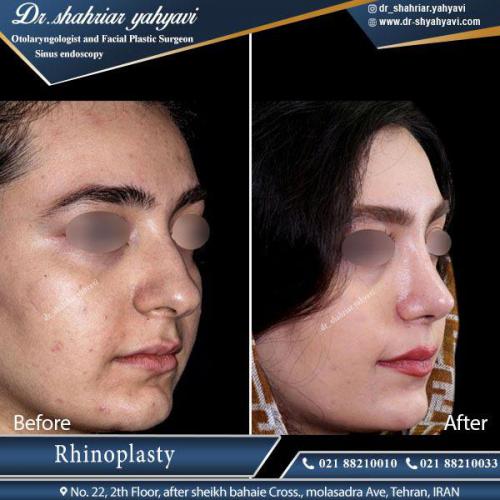 جراحی بینی 382 (1)