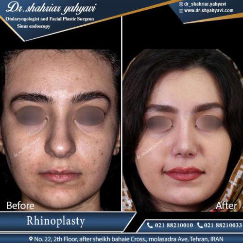 جراحی بینی 383