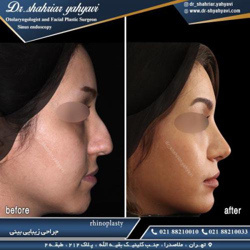 جراحی بینی 384