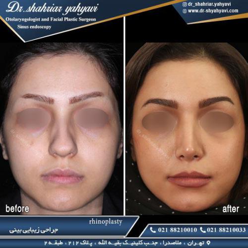 جراحی بینی 385