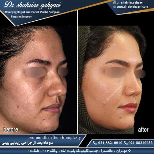 جراحی بینی 386