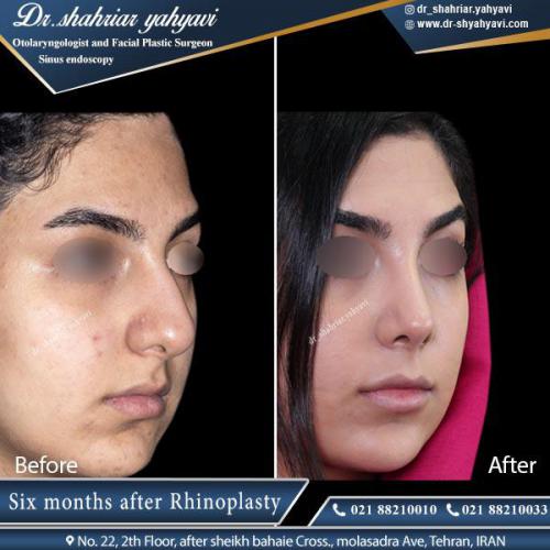 جراحی بینی 389