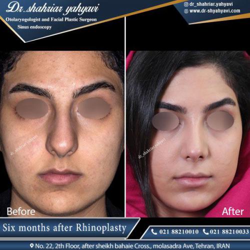 جراحی بینی 390