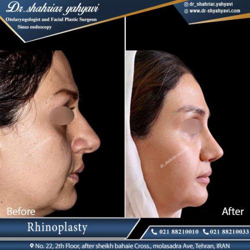 جراحی بینی 392