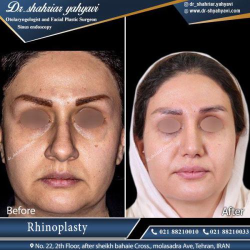 جراحی بینی 393