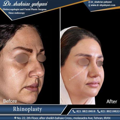 جراحی بینی 394