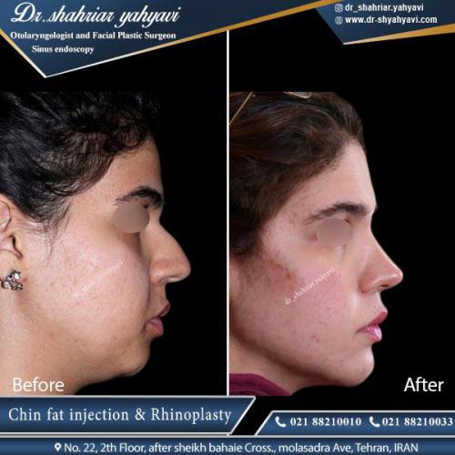 جراحی بینی 395