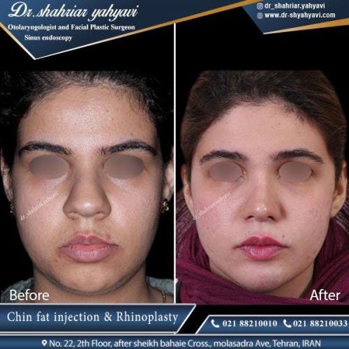 جراحی بینی 396