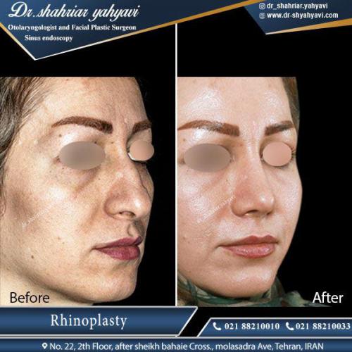 جراحی بینی 397