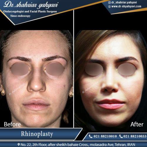 جراحی بینی 398
